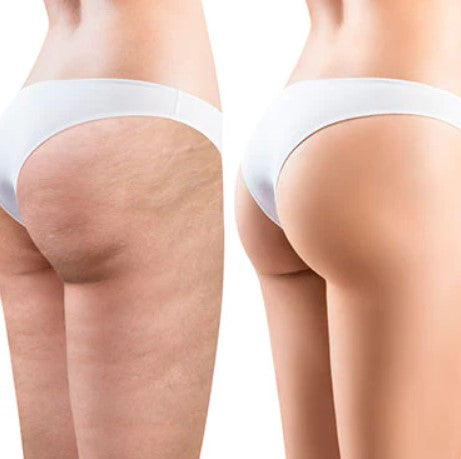 Crema Anticelulitis 4D